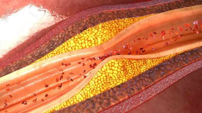 風口 | 冠脈鈣化&ldquo;終結(jié)者&rdquo;&mdash;&mdash;血管內(nèi)沖擊波