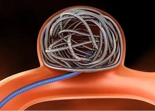  MA市場準(zhǔn)入 | 神經(jīng)介入②顱內(nèi)彈簧圈系統(tǒng)-臨床評價(jià)路徑